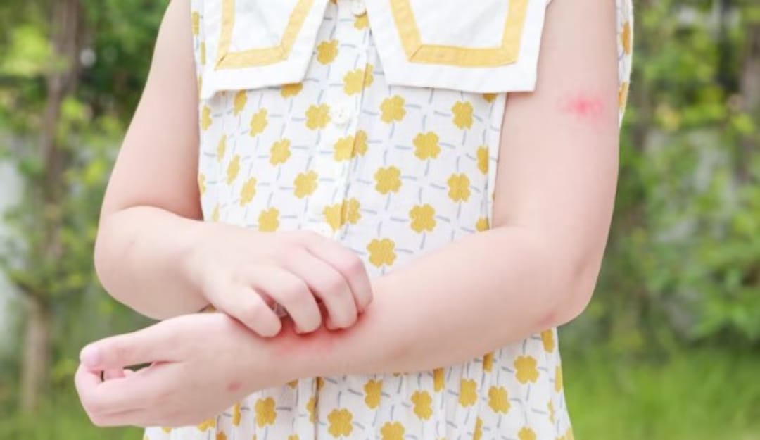 Penyebab Munculnya Dermatitis Numularis Pada Anak